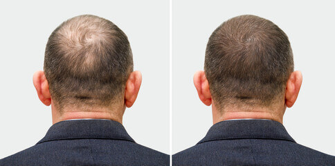 Age-defying hair growth results